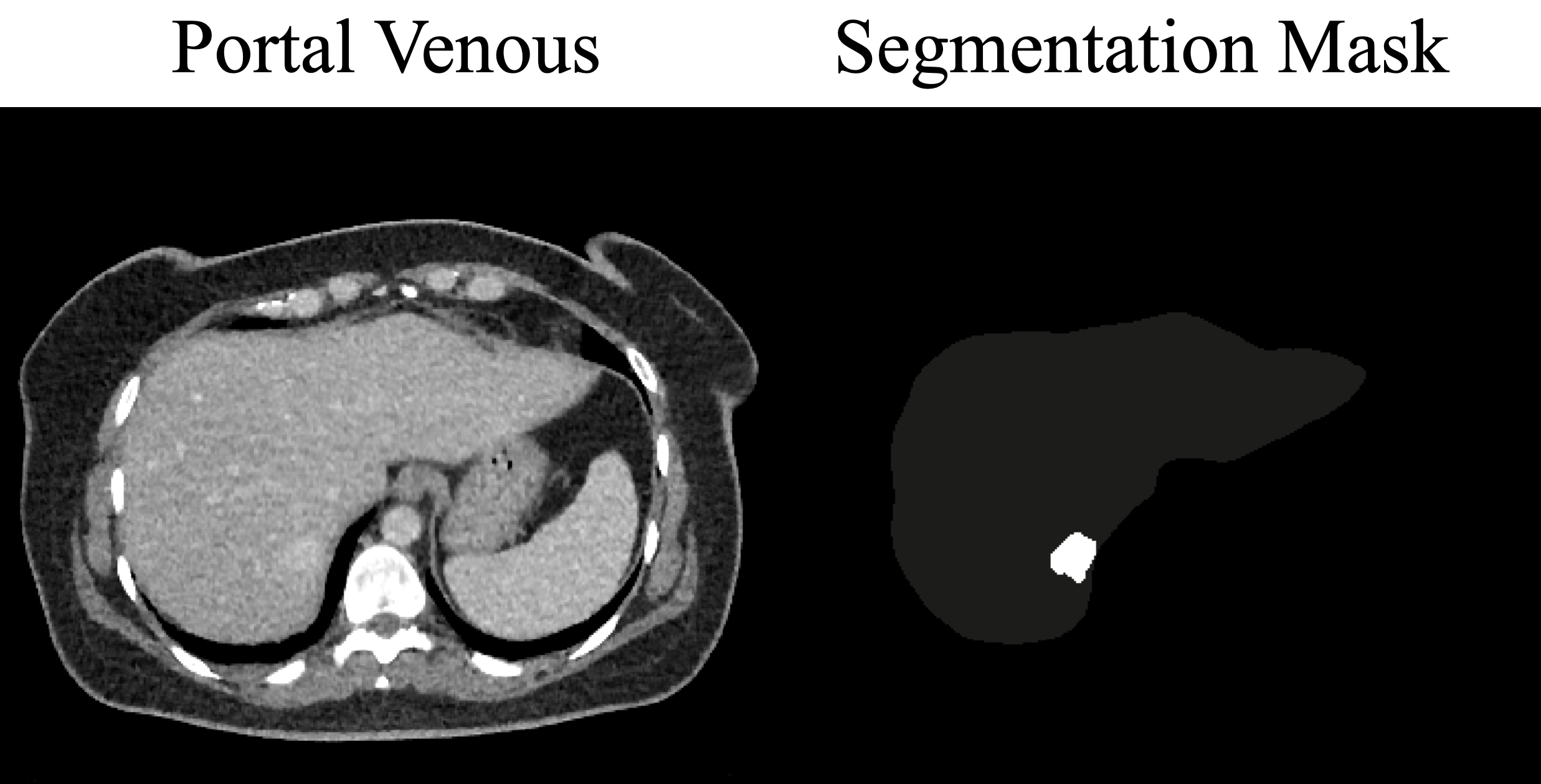 Sample case: venous CT and lesion label