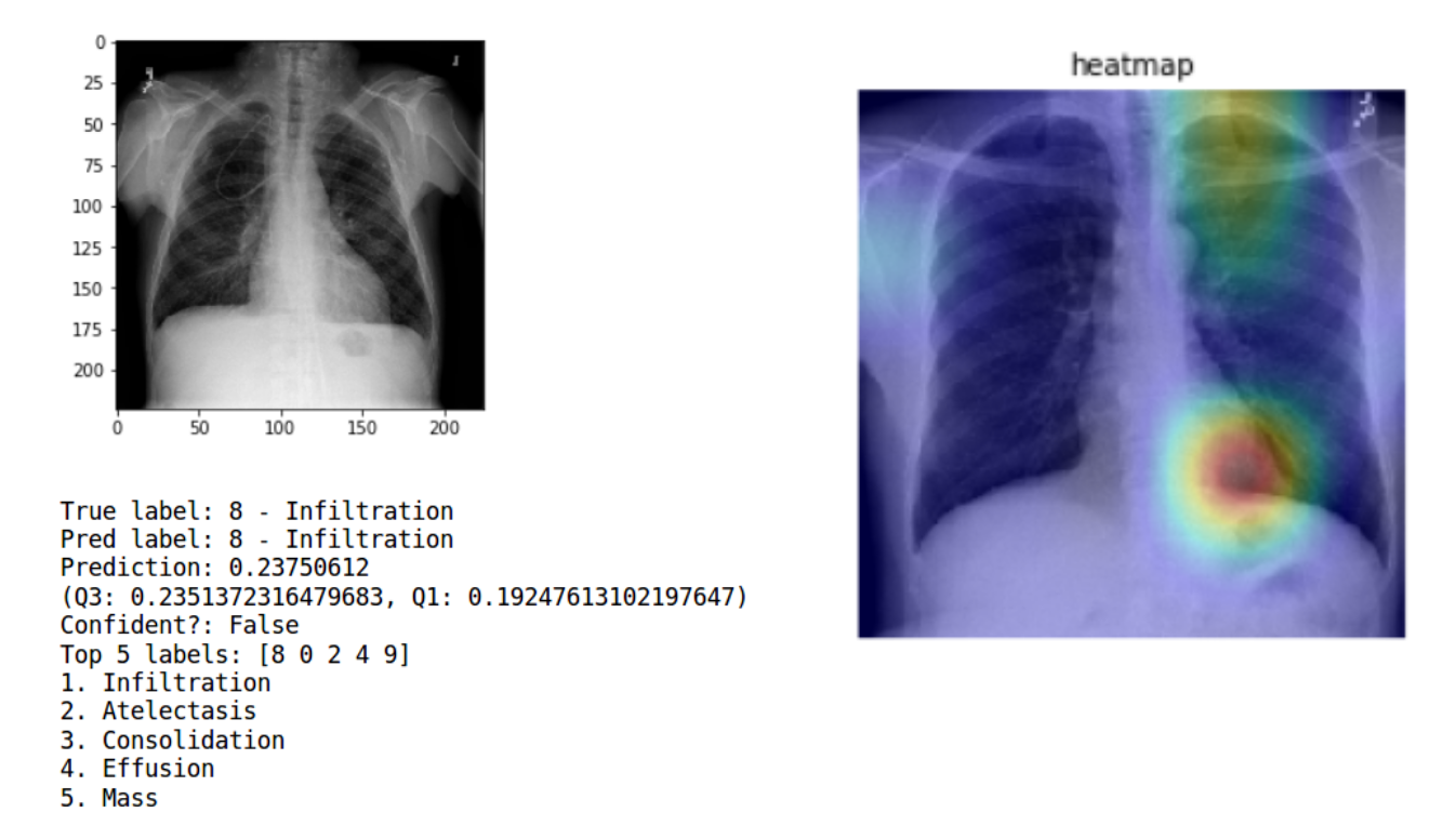 Nih Chest Xrays 