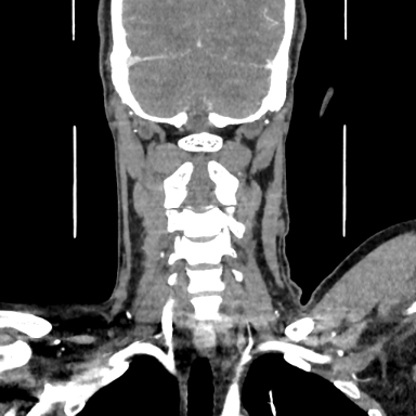 picture: Coronal